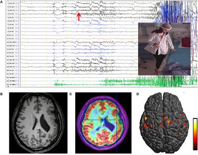 Multiple Stereoelectroencephalography-Guided Radiofrequency Thermocoagulations for Polymicrogyria With Startle Seizures: A Case Report